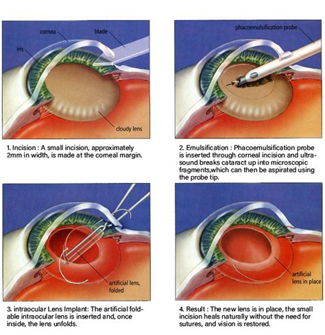 cataract surgery in huddersfield|The Huddersfield Hospital .